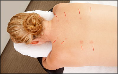 https://owensphysicaltherapy.com/wp-content/uploads/2018/09/dry-needling-2.jpg